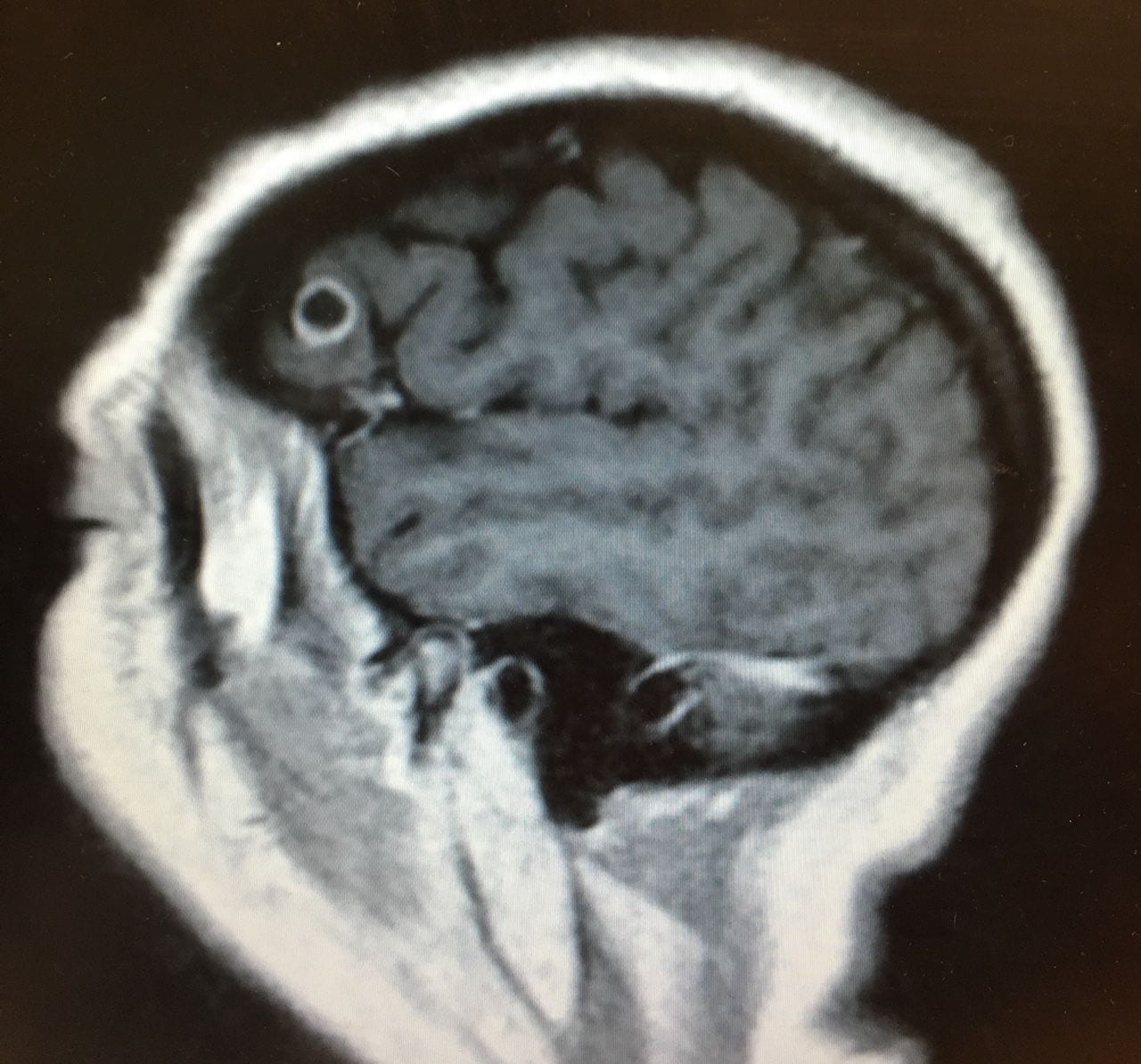 A scan showing the tapeworm in Rachel Palma's brain. (Mount Sinai Health System)