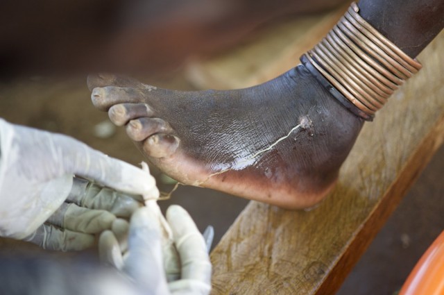 3. extracting a guinea worm