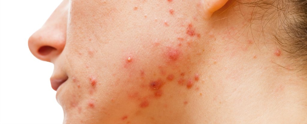 Researchers think they've finally figured out why bacteria only causes acne in some people