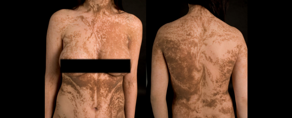 This rare disease reveals the patterns of our skin cell growth dermatology body diagram 