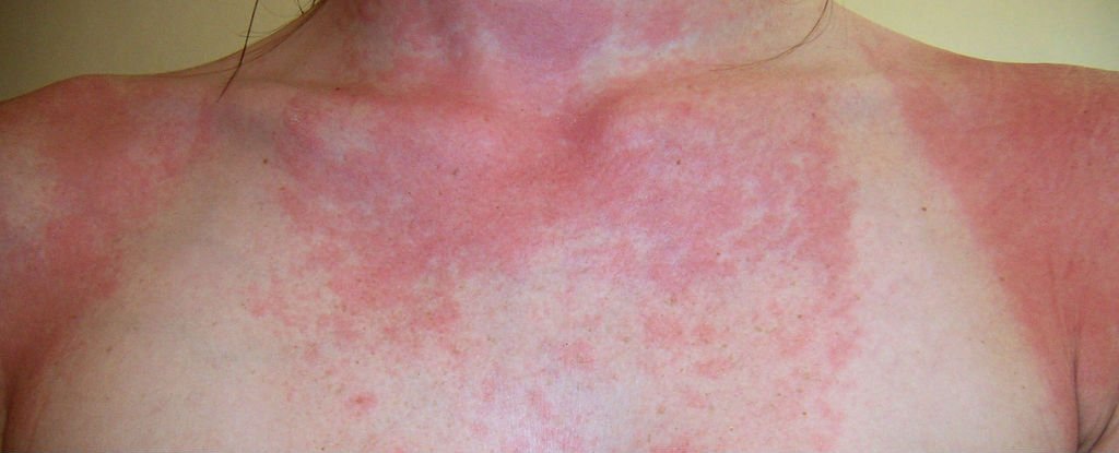 Sun Allergy Rash Pictures | MedicalPictures.net
