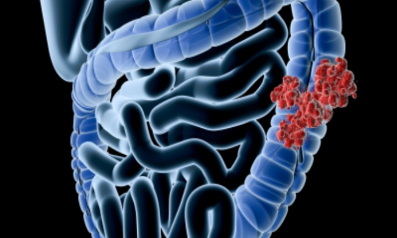 RayCat_bowelcancer_iStock