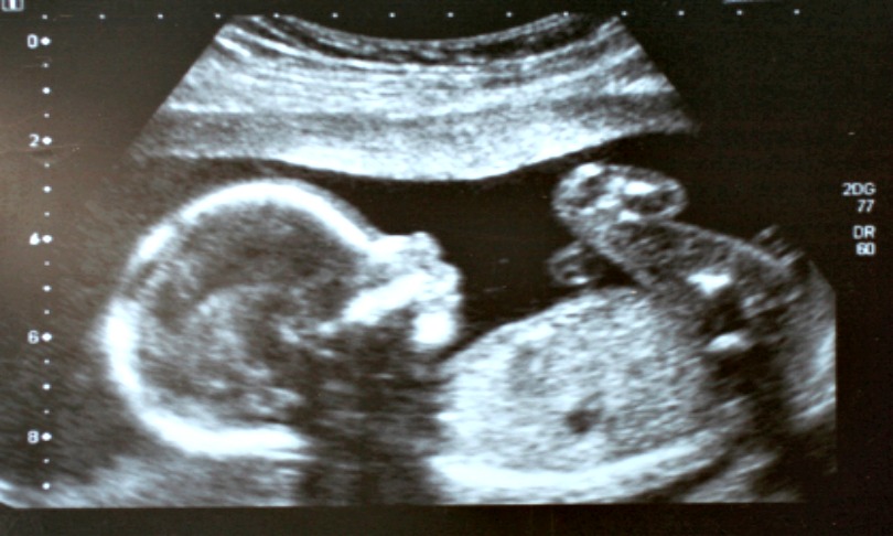 YsaL_pregnancy_iStock