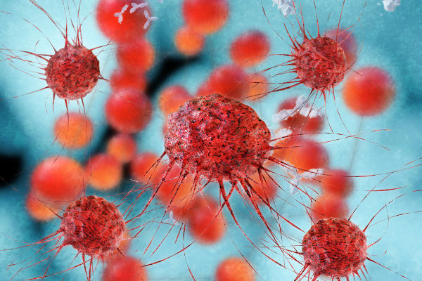 cancer-breast