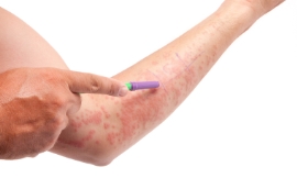 gokhanilgaz_-_allergic_rash