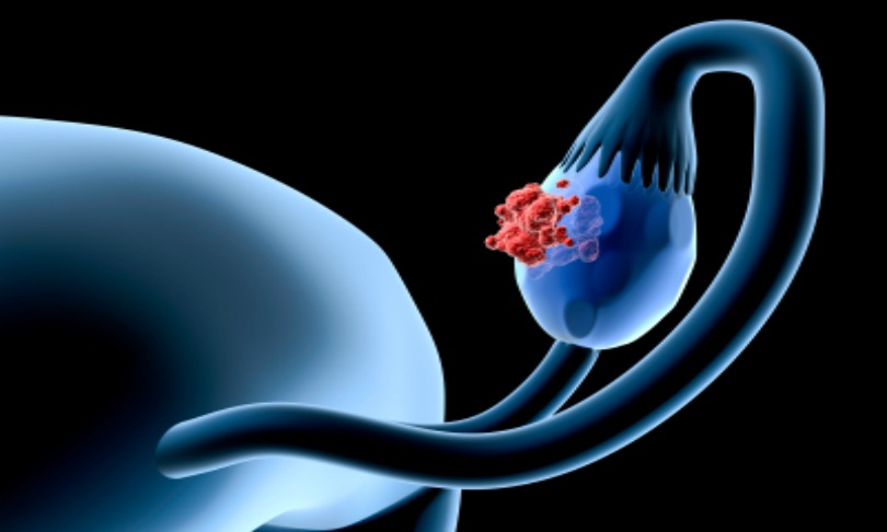 raycat_ovary_iStock