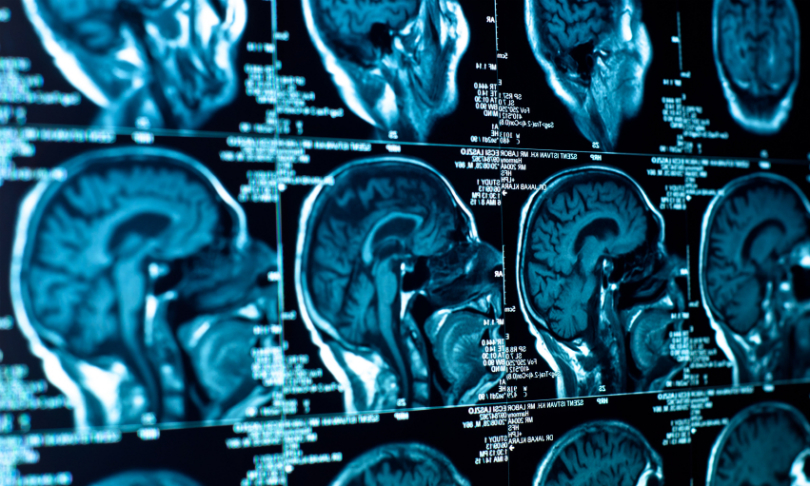 svedoliver_Brain_iStock