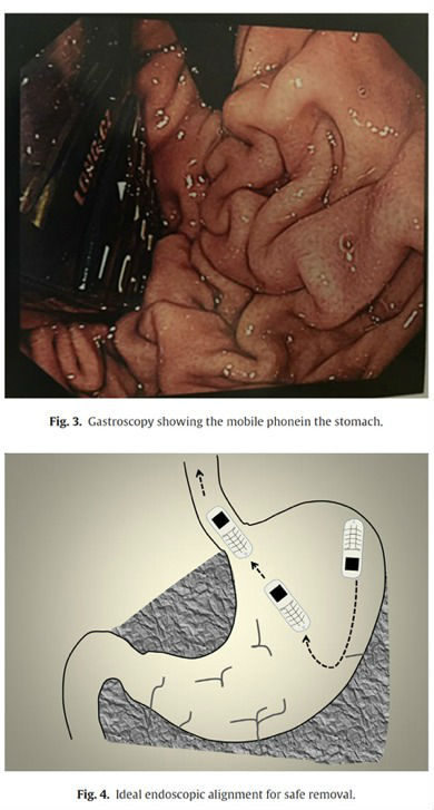 phone-stomach-2