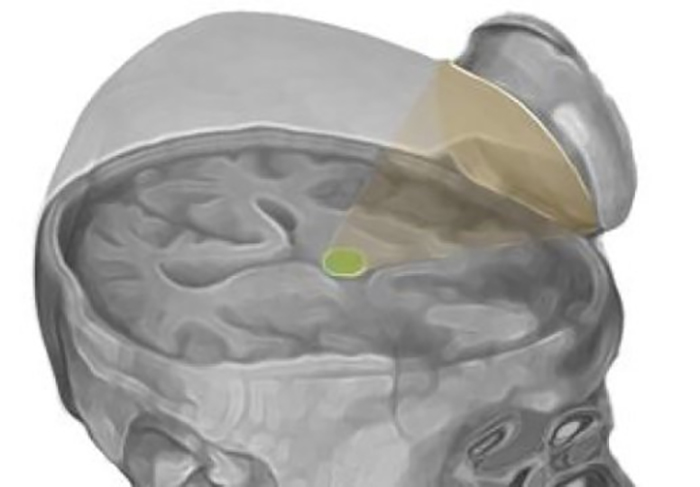 thalamus-2