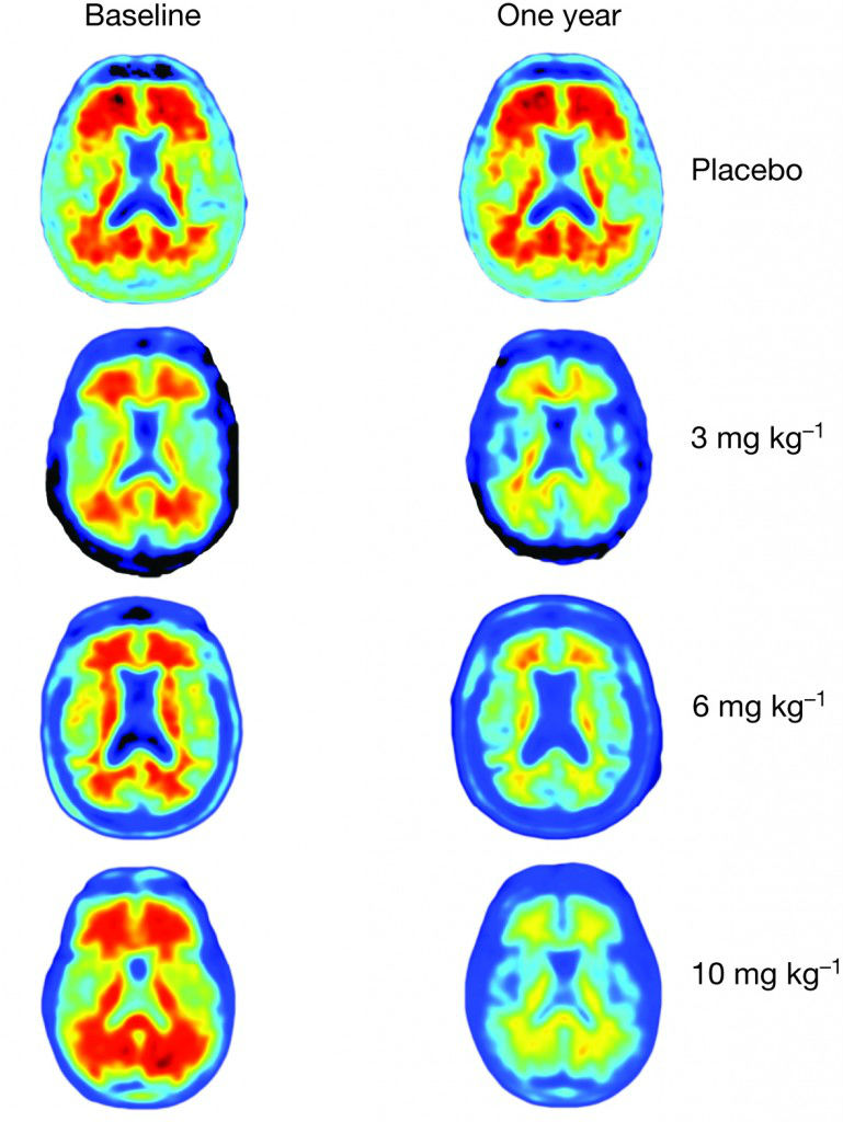 amyloid-plaques-aducanumab