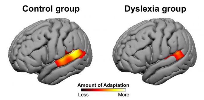 9867322346-dyslexia-3