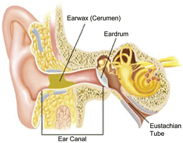 earwax-2