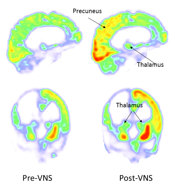 before and after vns brain scans activity