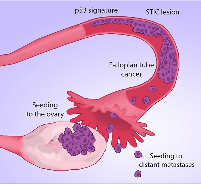 New Evidence Suggests Ovarian Cancer Might Not Start In The Ovaries