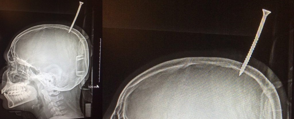 13-Year-Old Was a "Millimetre Away" From Death After Huge Screw Pierced His Brain