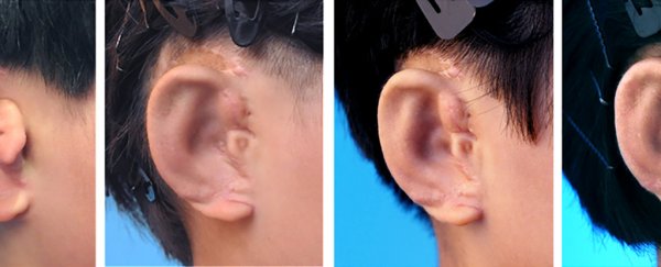 5 children have new ears grown from their own cells in a world first