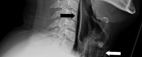 A man tore a hole in his throat trying to hold back a sneeze