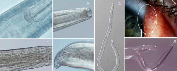 A woman had 14 worms in her eye and doctors didn't even know it was possible