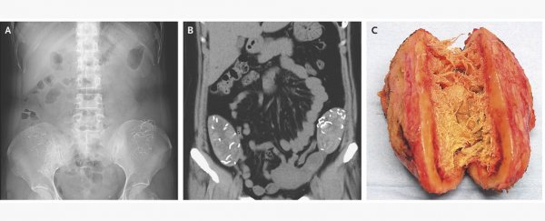 This woman had surgical sponges left in her abdomen for at least 6 years