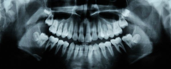 An Alzheimer's drug has been shown to help teeth repair cavities naturally