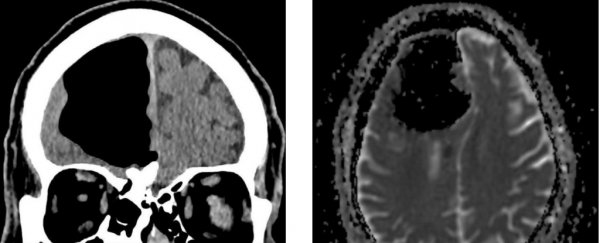 This man had a chunk of his brain go "missing" for a very strange reason