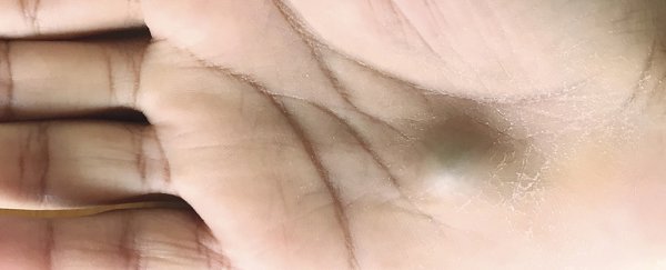 A man got a pulsating bump on his palm, and it turned out to be linked to his heart