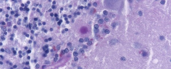 Devastating prion disease can lurk in your brain for 30 years before attacking