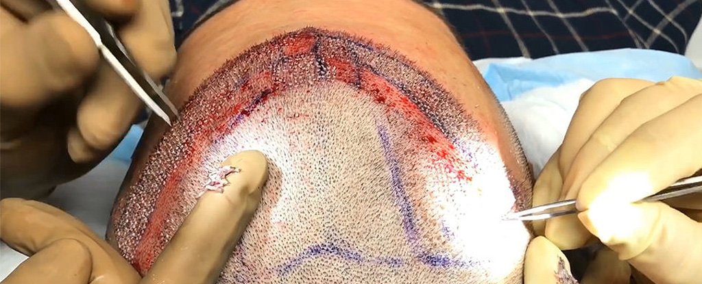 These Are The Only Things That Can Cure Baldness, According to Science