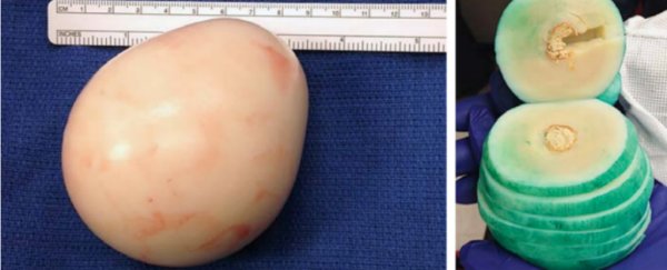 This huge rubbery mass was floating around a man's abdomen for years