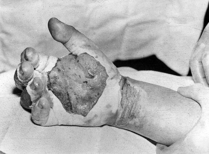 A mão queimada e cheia de bolhas de Daghlian. (Laboratório Nacional de Los Alamos)