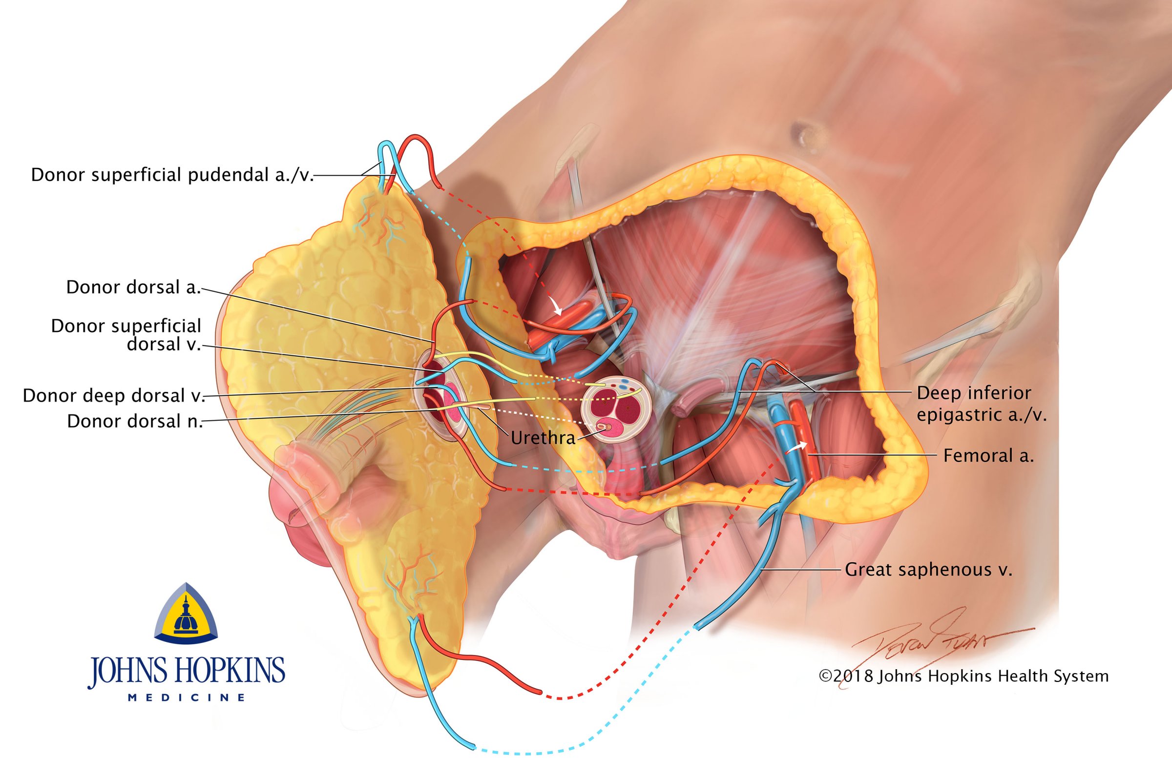 diagrama de peniletransplant
