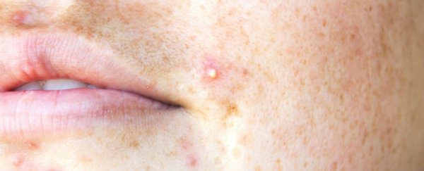 Common vitamin has been linked to a higher risk of acne