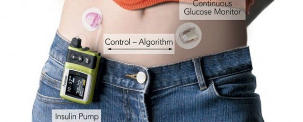 Revolutionary 'artificial pancreas' is proving to be incredible for type 1 diabetics