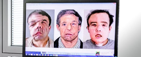 'The man with three faces': world-first face transplant replacement is a success