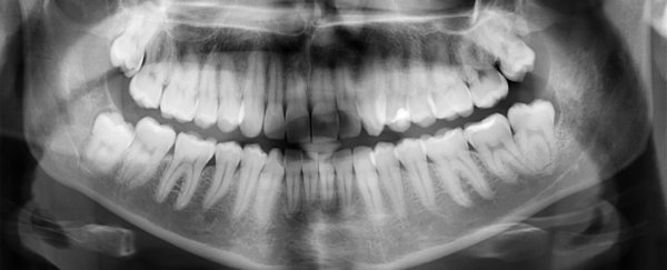 Ingeniously simple dental treatment could heal tooth cavities without any fillings