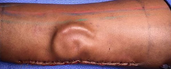 A soldier lost her ear in an accident, so doctors grew a new one in her arm