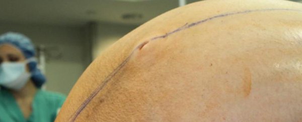 A tumour that weighs as much as an adult human was removed from a woman's ovary