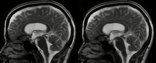 Watch what happens to your brain when the heart pumps blood