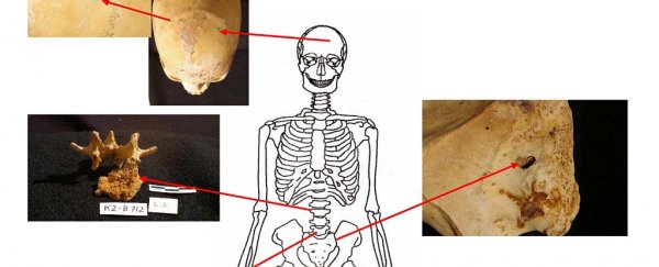 Cancer discovered in Ancient Egyptian remains shows these days we have it much worse