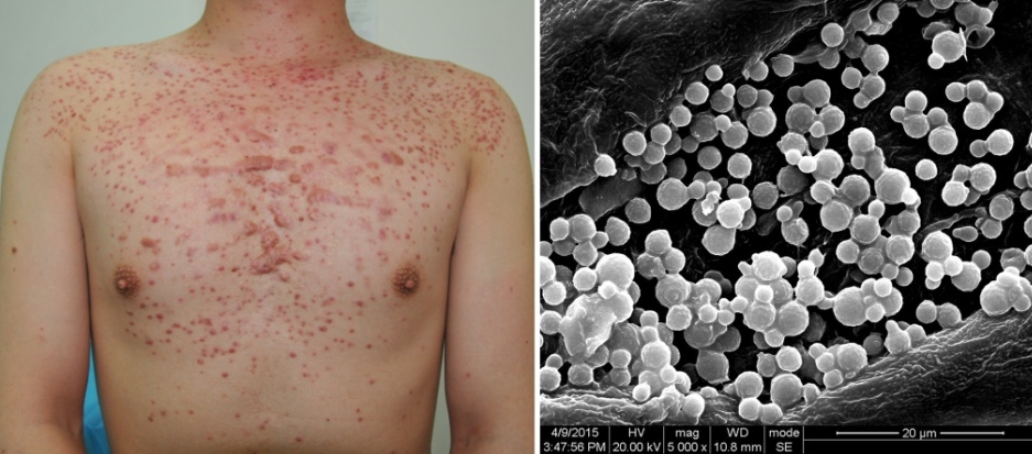 Pityrosporum folliculitis 2