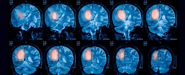 There's no clear link between brain cancer and electromagnetic fields, says largest study yet