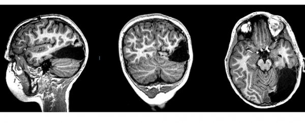 This boy lost one-sixth of his brain, but the amazing part is how his brain adapted