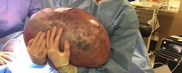 A woman kept gaining weight and didn't know why. It was a 50-pound ovarian cyst