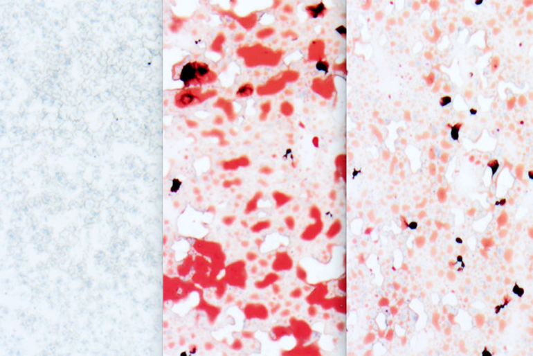 fatty liver comparison 770