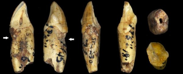 Ancient human ancestors had the same dental problems as us, even without refined sugars and fizzy drinks