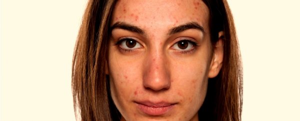 A potential acne vaccine just passed an important early test, and it can't come soon enough