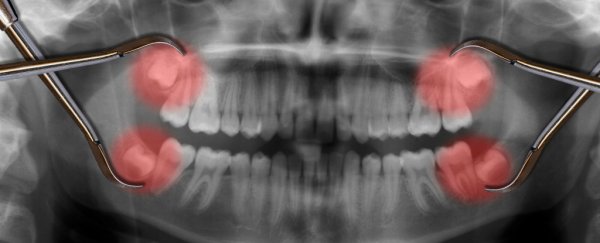 Getting your wisdom teeth removed could increase your risk of opioid addiction