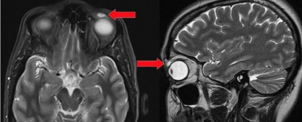 This woman had something stuck in her eyelid for 28 years without noticing