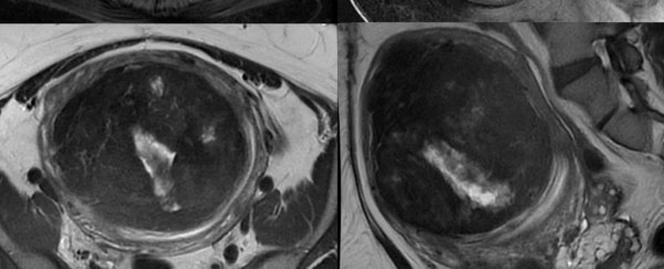 A woman was struggling to breathe — because of a 61-pound tumor in her uterus