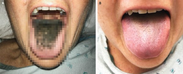A rare case of black hairy tongue has been recorded in the US